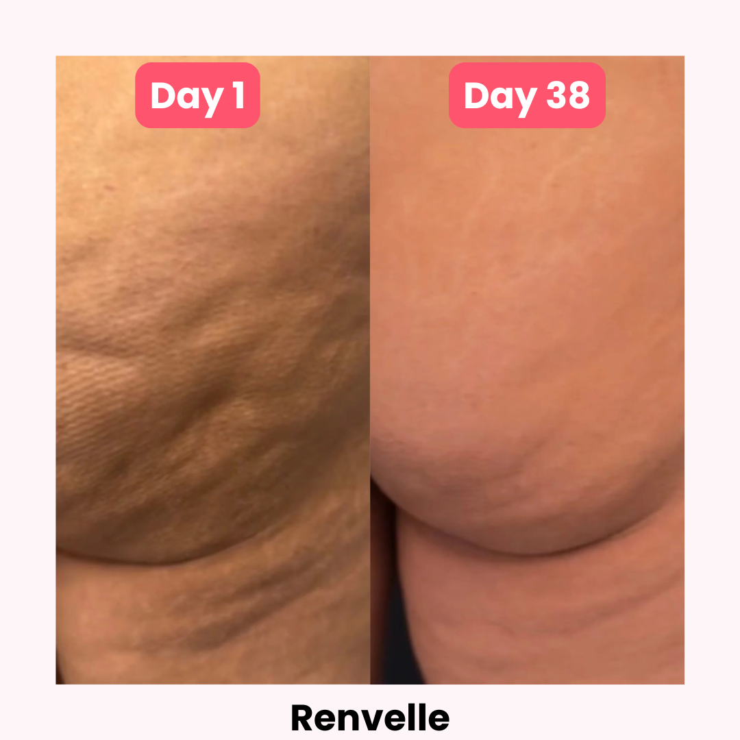 Renvelle - Cellulite Sculpt System