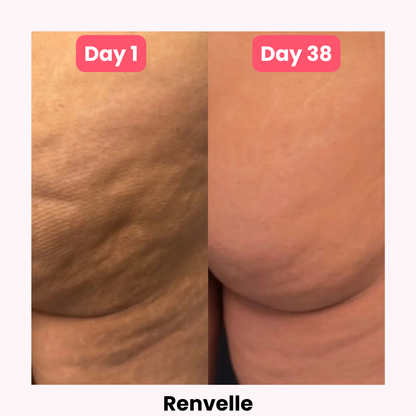 Renvelle - Cellulite Sculpt System